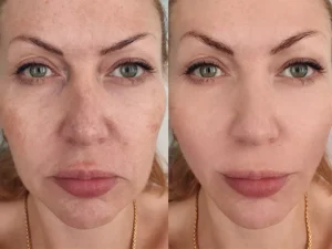 blog-09-antes-e-depois-do-radiesse-no-rosto