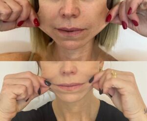 radiesse-antes-e-depois06