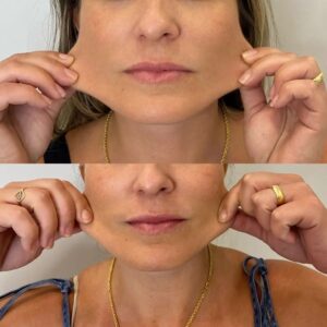 radiesse-antes-e-depois12